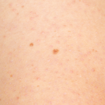 Keratosis Pilaris | White Rock Dermatology | Skin Irritation Treatment, TX.