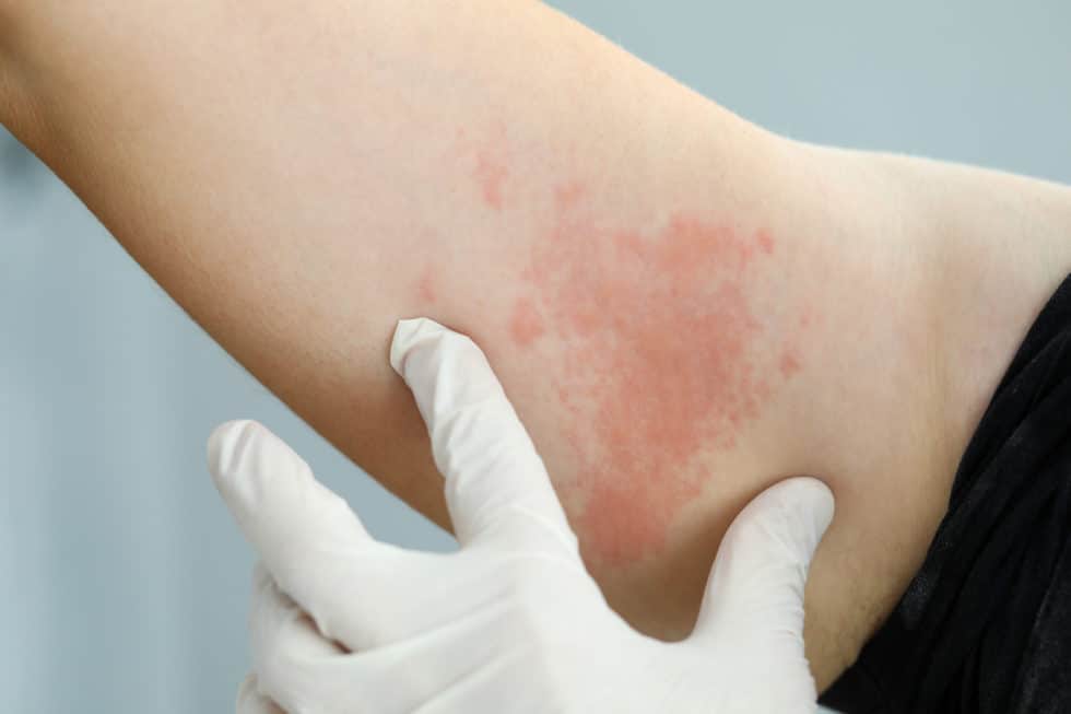 Hives | White Rock Dermatology