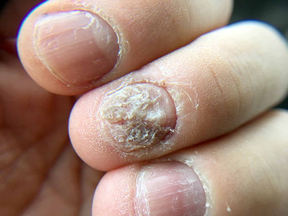 Top 10 Most Common Nail Diseases  Disorders  ProMed Clinic