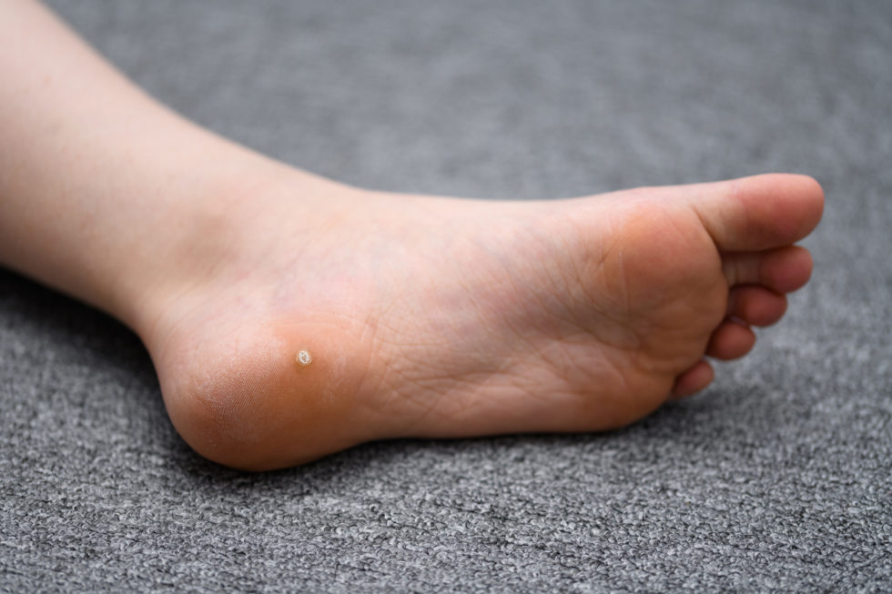 warts-white-rock-dermatology