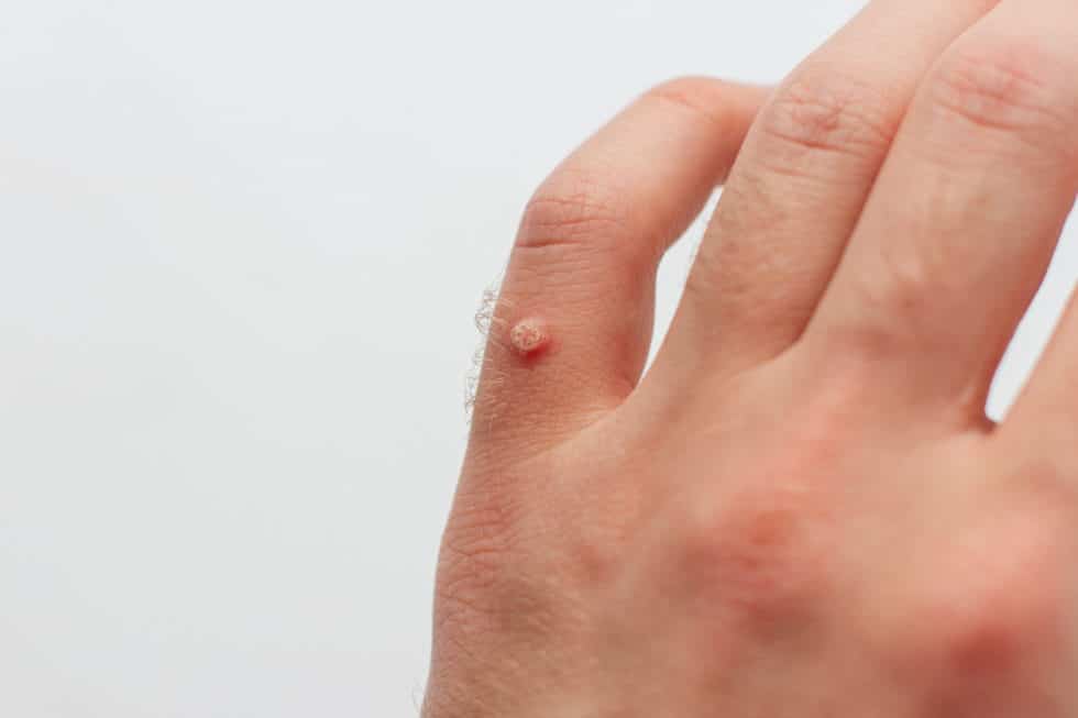 warts-white-rock-dermatology