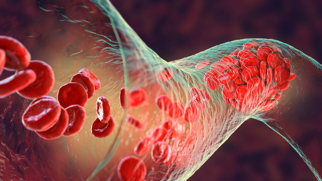 Blood clot made of red blood cells, platelets and fibrin protein strands. Thrombus, 3D illustration