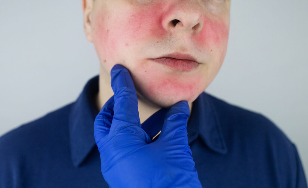 The man suffers from redness on her cheeks. Couperose of the skin. Redness and capillary mesh are visible on the face. Treatment and removal. Vascular surgery and dermatology. Rosacea face.