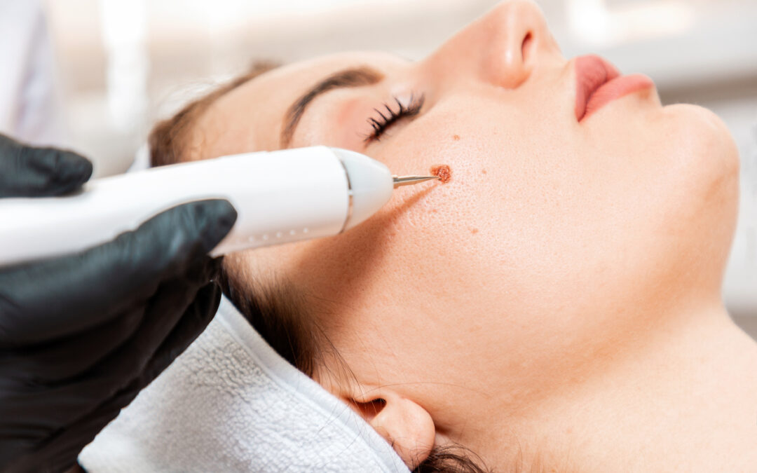 Professional salon procedures. Surgeon using a laser device for removing mole. Removal of birthmark from female face. Close up. Concept of laser cosmelotogy and electrocoagulation.