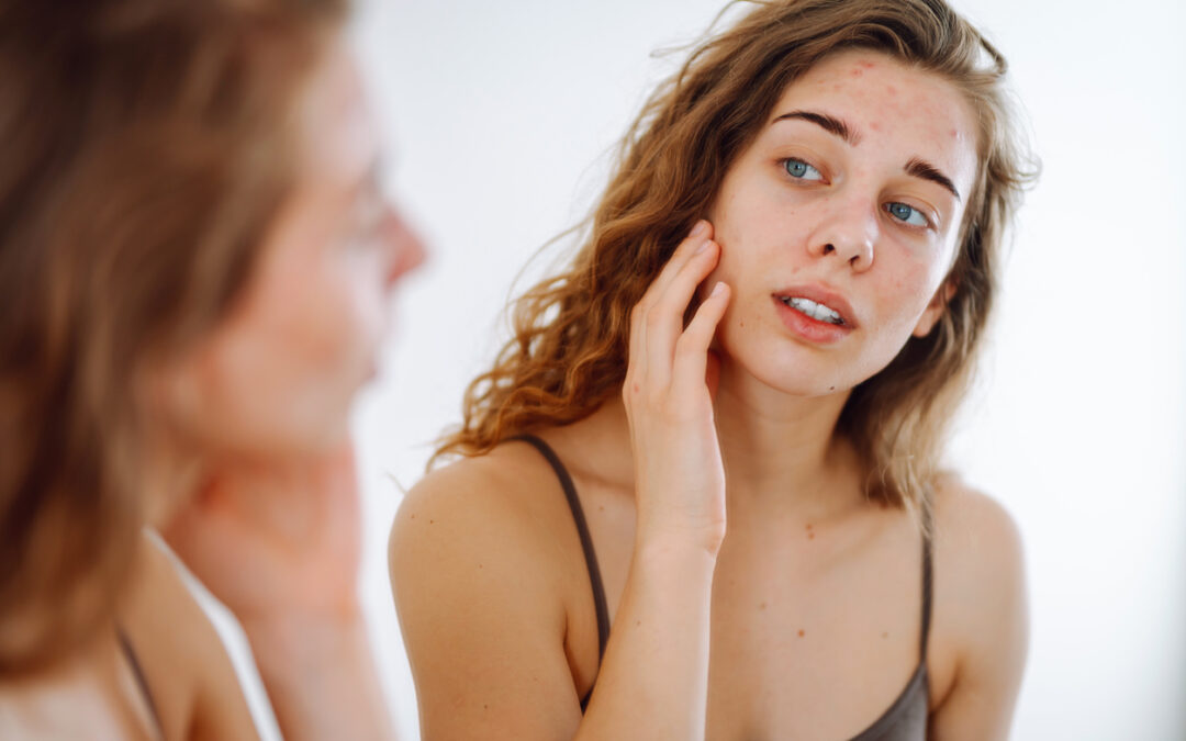 Close-up of a young woman looking at pimples in the mirror. Beautiful woman with acne problem skin checks dry face skin. Red spots, rash, acne. Skin treatment.