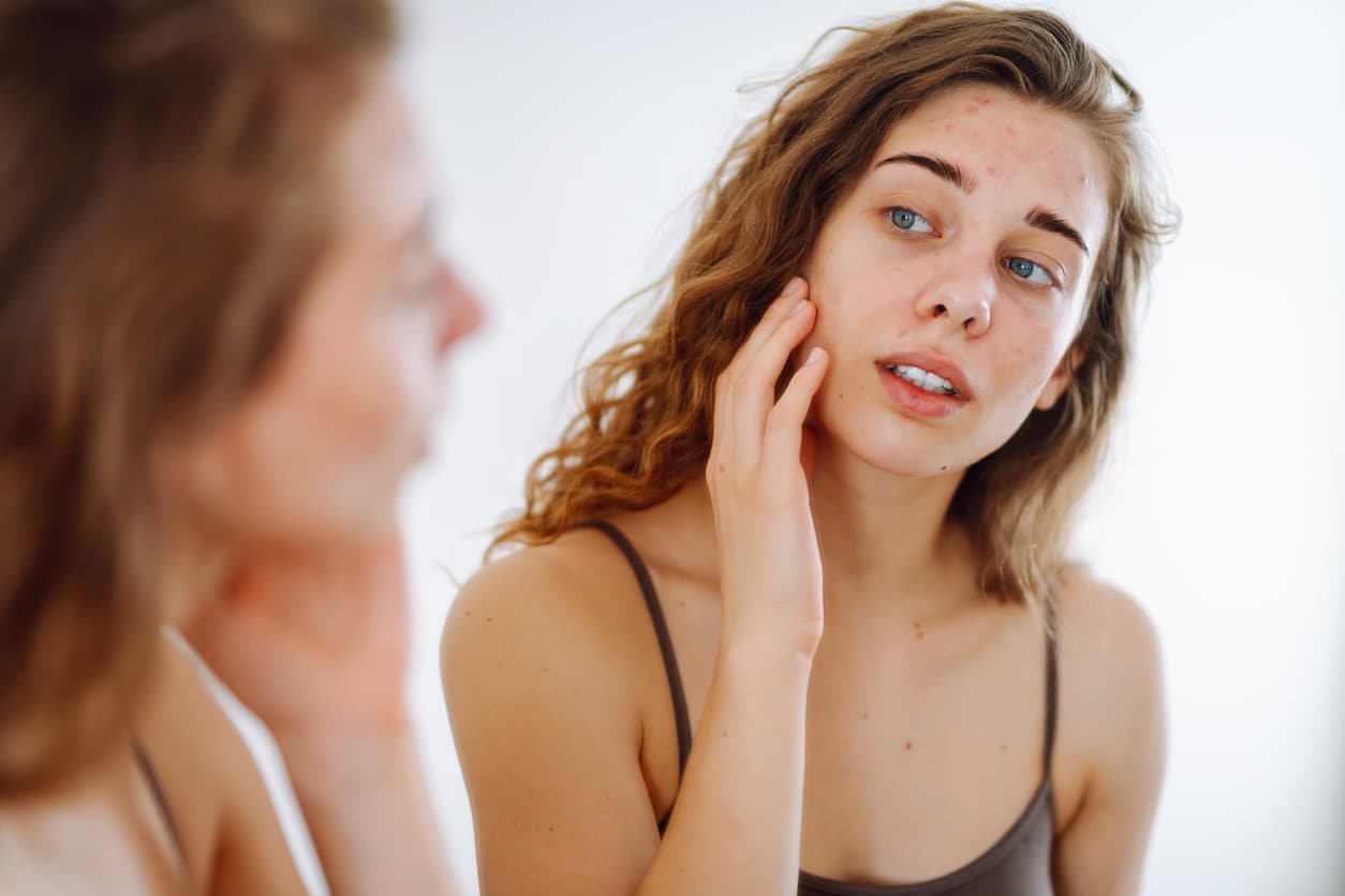 Close-up of a young woman looking at pimples in the mirror. Beautiful woman with acne problem skin checks dry face skin. Red spots, rash, acne. Skin treatment.
