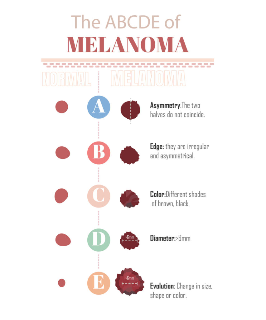 The ABCDE of melanoma, to know if you have a melanoma, on a white background.