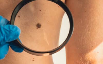 Is That Just a Mole or Something More? The ABCDEs of Skin Cancer Screening