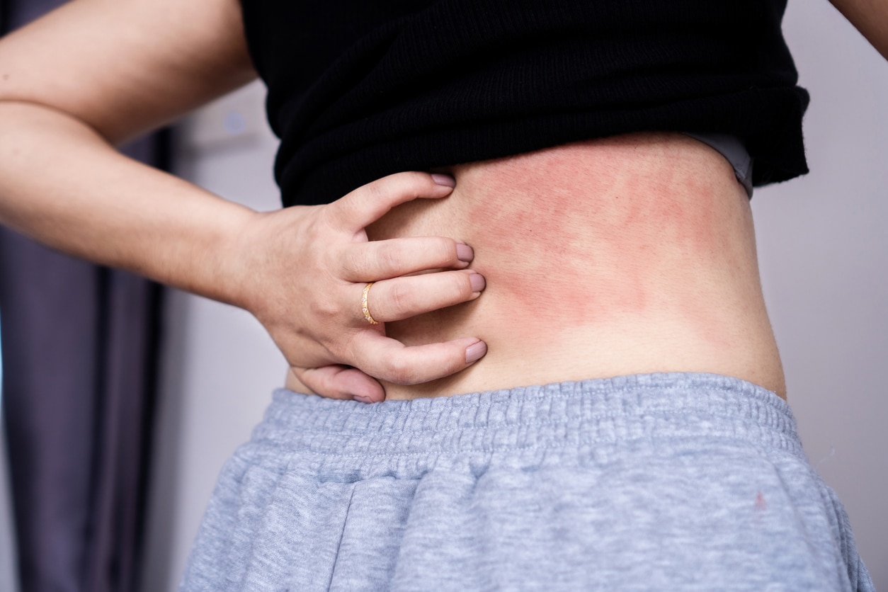 woman suffering from skin disease hand scratching on her back that redness and itchy due to allergy to sweat